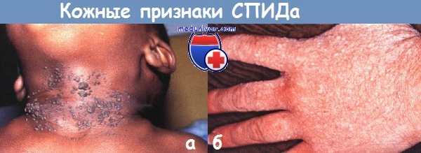 Кожные признаки СПИДа