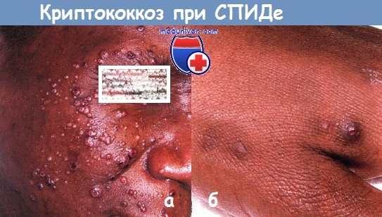 Криптококкоз при СПИДе