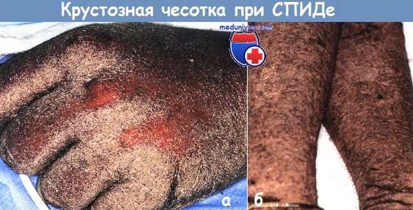 Крустозная чесотка при СПИДе