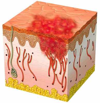 образование сыпи при васкулите