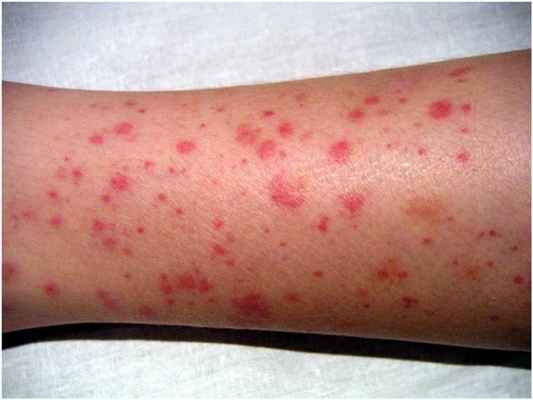 сыпь при васкулите
