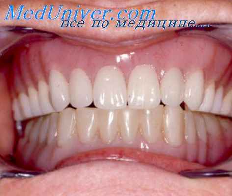 протезные стоматиты