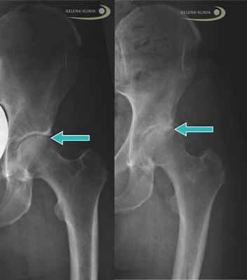 Слева: Рентген здорового бедра у взрослого. Стрелой отмечена суставная щель между крышей вертлужной впадины (Acetabulum) и головкой бедренной кости (Caput femoris). Справа: Рентген тазобедренного сустава, изменённого вследствие артроза, неравномерные высветления указывают на дегенеративные изменения. © Gelenk-Klinik