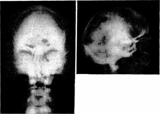 Утолщение свода черепа