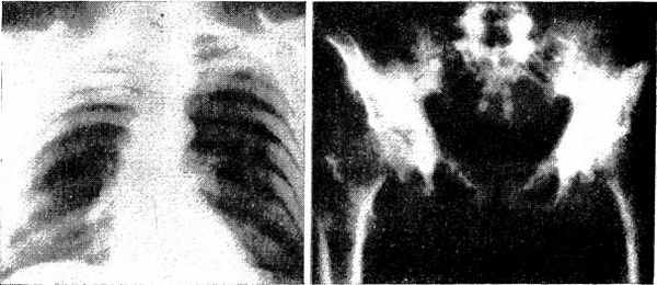 Уплотненные ребра с утолщенными трабекулами