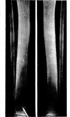 утолщение кортикального слоя в диафизах костей голеней и цилиндрическая форма большеберцовых костей