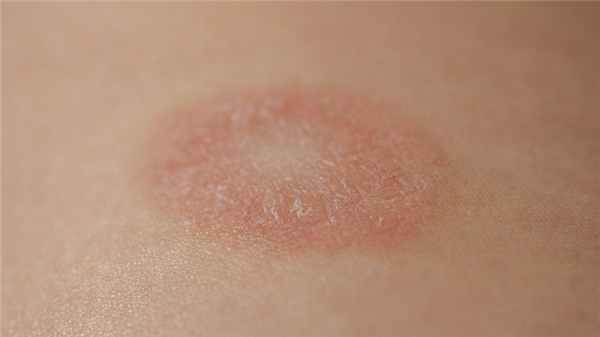 Красный плоский лишай у взрослых