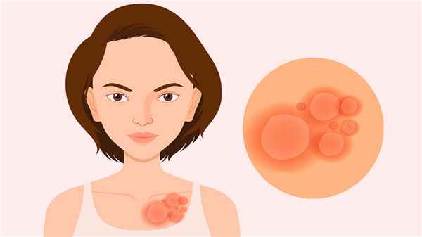 Красный плоский лишай