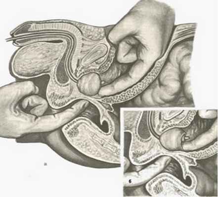 Аденомэктомия