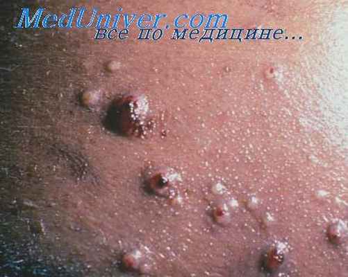 криптококкоз