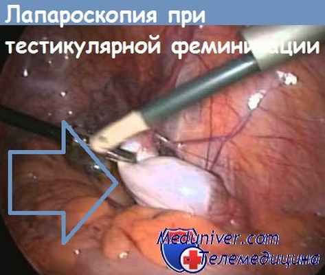 лапароскопия при синдроме тестикулярной феминизации