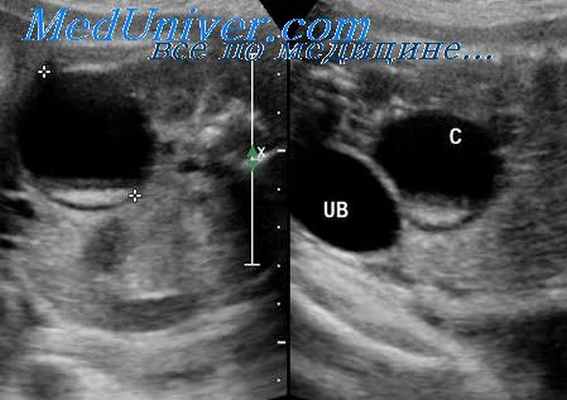 крипторхизм у плода