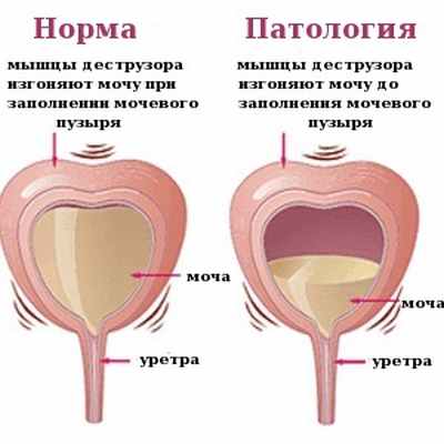 Учащенное мочеиспускание