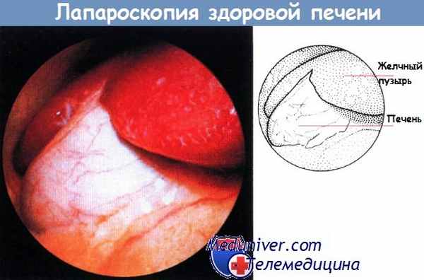 Лапароскопия здоровой печени