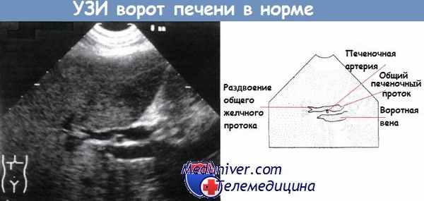 УЗИ ворот печени в норме