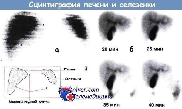 Сцинтиграфия печени и селезенки