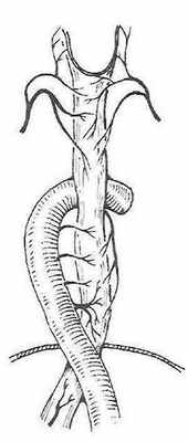 Артериальное кровоснабжение пищевода (схема, вид сзади)