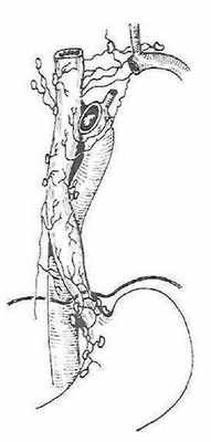 Внеорганная лимфатическая система пищевода, регионарные лимфоузлы