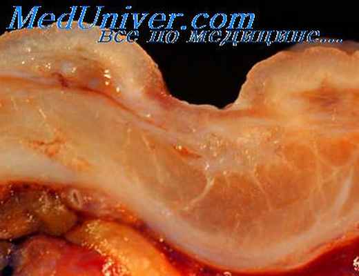 язва желудка