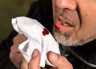 Кровохарканье: виды при разных причинах, быстрая диагностика в АМДЦ 