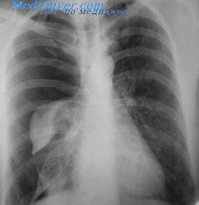 кровохарканье