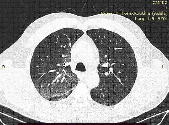 КТ-картина имбибиции верхней доли правого легкого