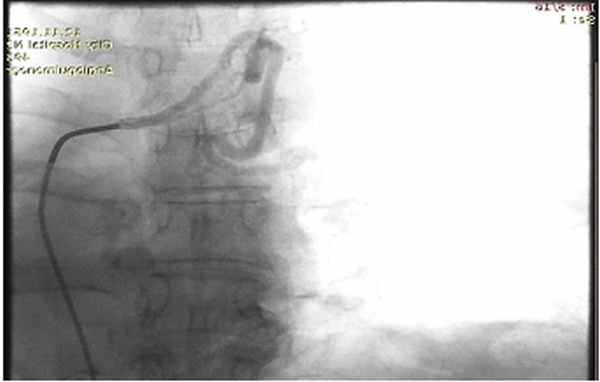 Патологически расширенная правая бронхиальная артерия