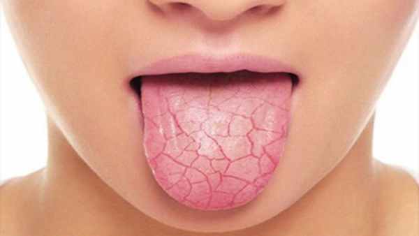 ксеростомия