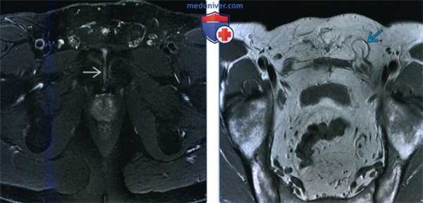 Лучевые признаки грыжи стенки живота