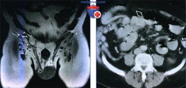Лучевые признаки грыжи стенки живота