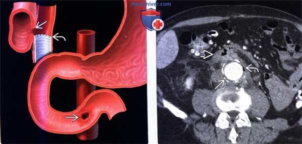 Лучевая диагностика аорто-энтеральной фистулы