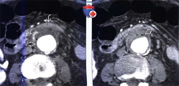 Лучевая диагностика аорто-энтеральной фистулы