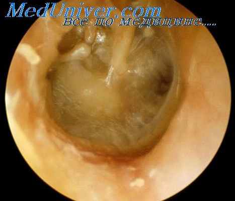 барабанная перепонка