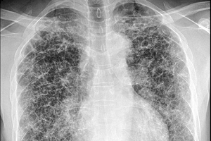 Гистиоцитоз X