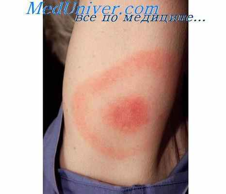 мигрирующая эритема