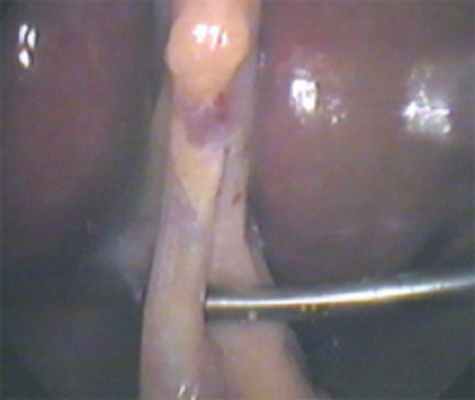 Удаление желчного пузыря лапароскопия