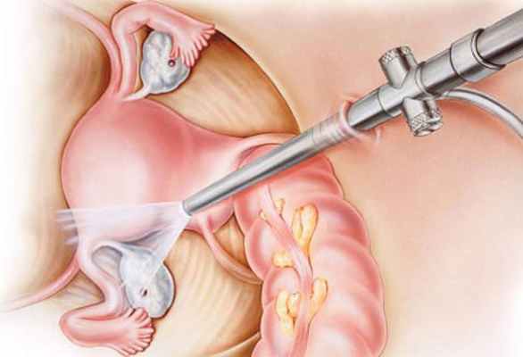 Лапароскопическая операция в гинекологии