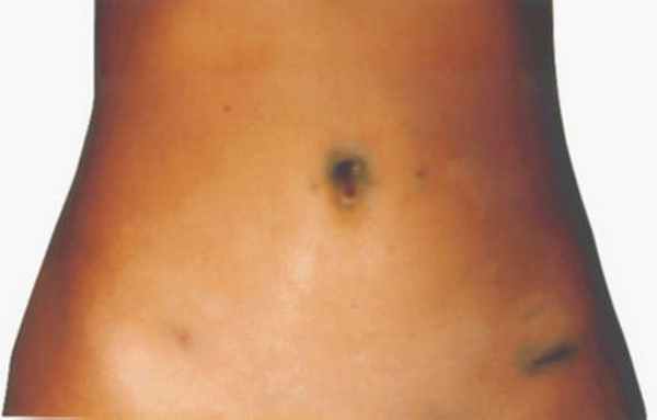 Внешний вид ран после лапароскопической гинекологической операции (4-й день после операции)