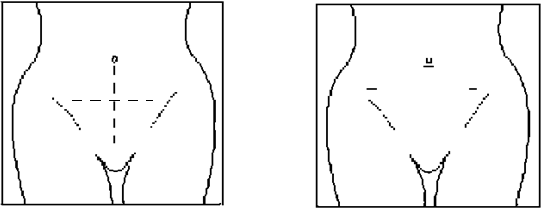 Разрез передней брюшной стенки при обычной и лапароскопической операции