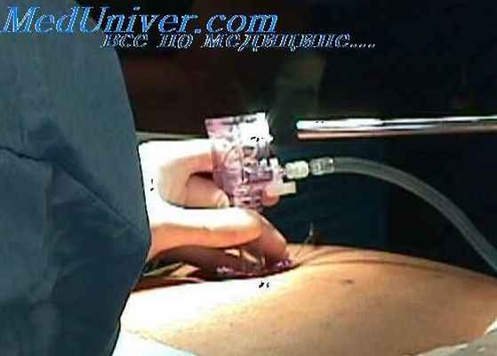 лапароскопия