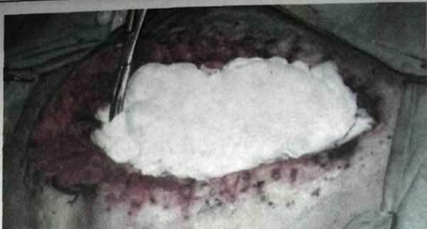 Этап рыхлого тампонирования срединной раны марлевыми салфетками, пропитан­ными мазью «Левосин»