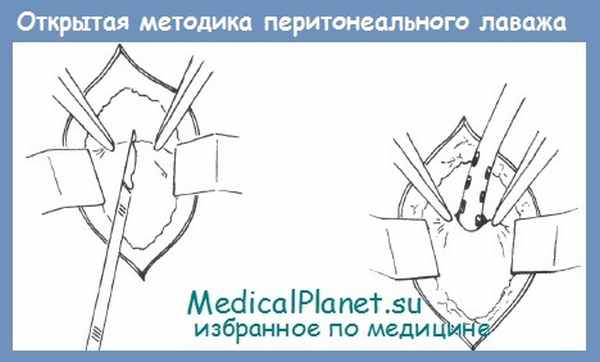 Диагностический перитонеальный лаваж (DPL)