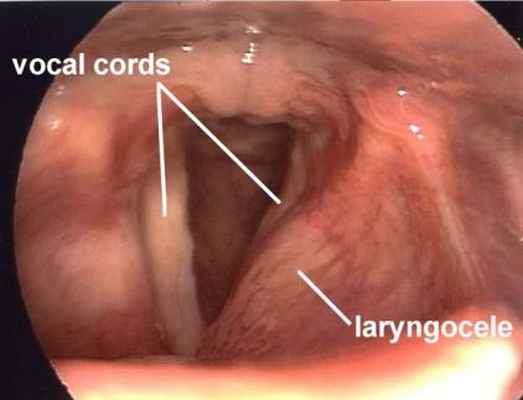 Ларингоцеле