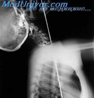 травмы гортани