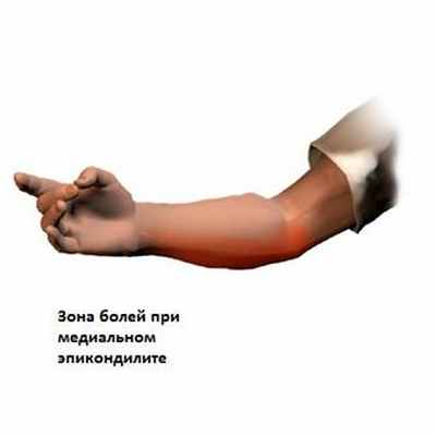 Эпикондилит