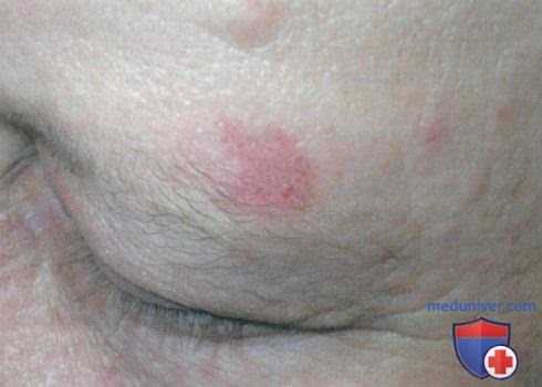 Актинический кератоз и болезнь Боуэна