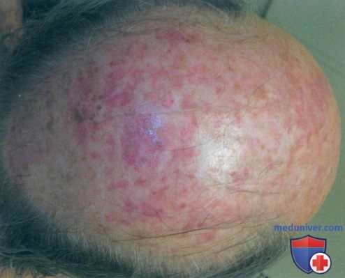 Актинический кератоз и болезнь Боуэна