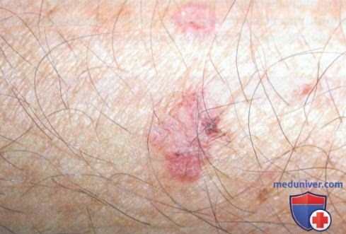 Актинический кератоз и болезнь Боуэна