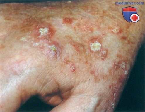 Актинический кератоз и болезнь Боуэна