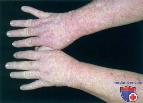 Актинический кератоз и болезнь Боуэна